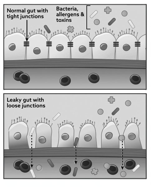 Leaky Gut